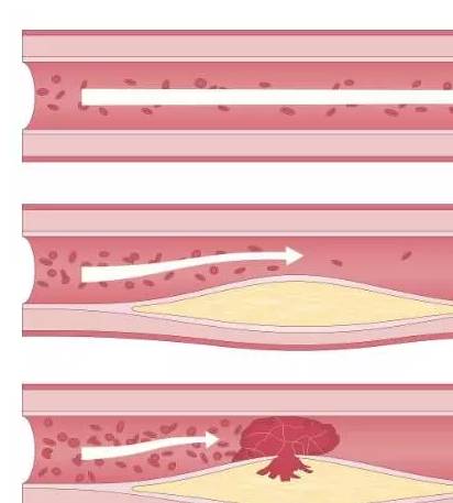 Ԥ�����˻�֢_����Ѫ�ܲ�Ԥ��ʳ��_�԰��ʲ��������Ѫ����Χ��϶������