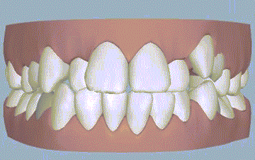 矫正牙齿_矫正牙齿期间的食谱_一般矫正牙齿多少钱